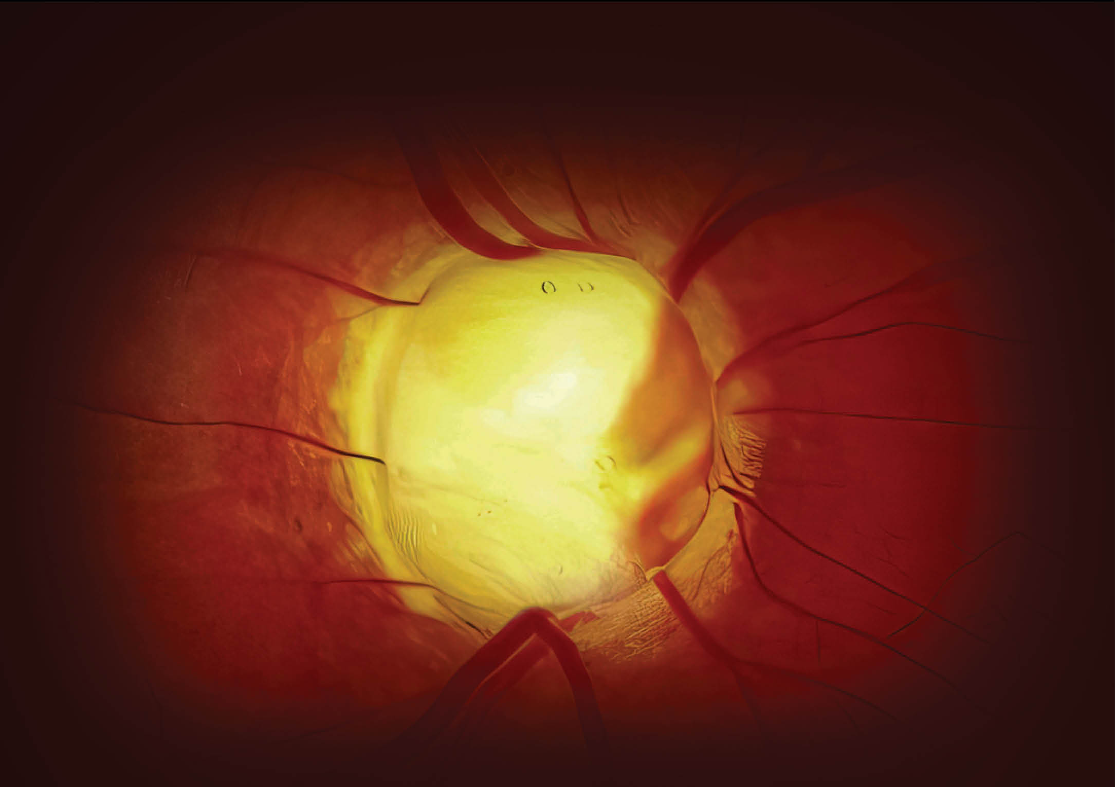 https://soliseyecare.com/wp-content/uploads/2025/07/Diabetic-Retinopathy_03.jpg