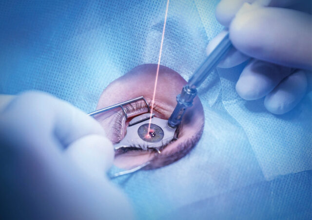 LASIK & Refractive Surgery - Solis Eye Care
