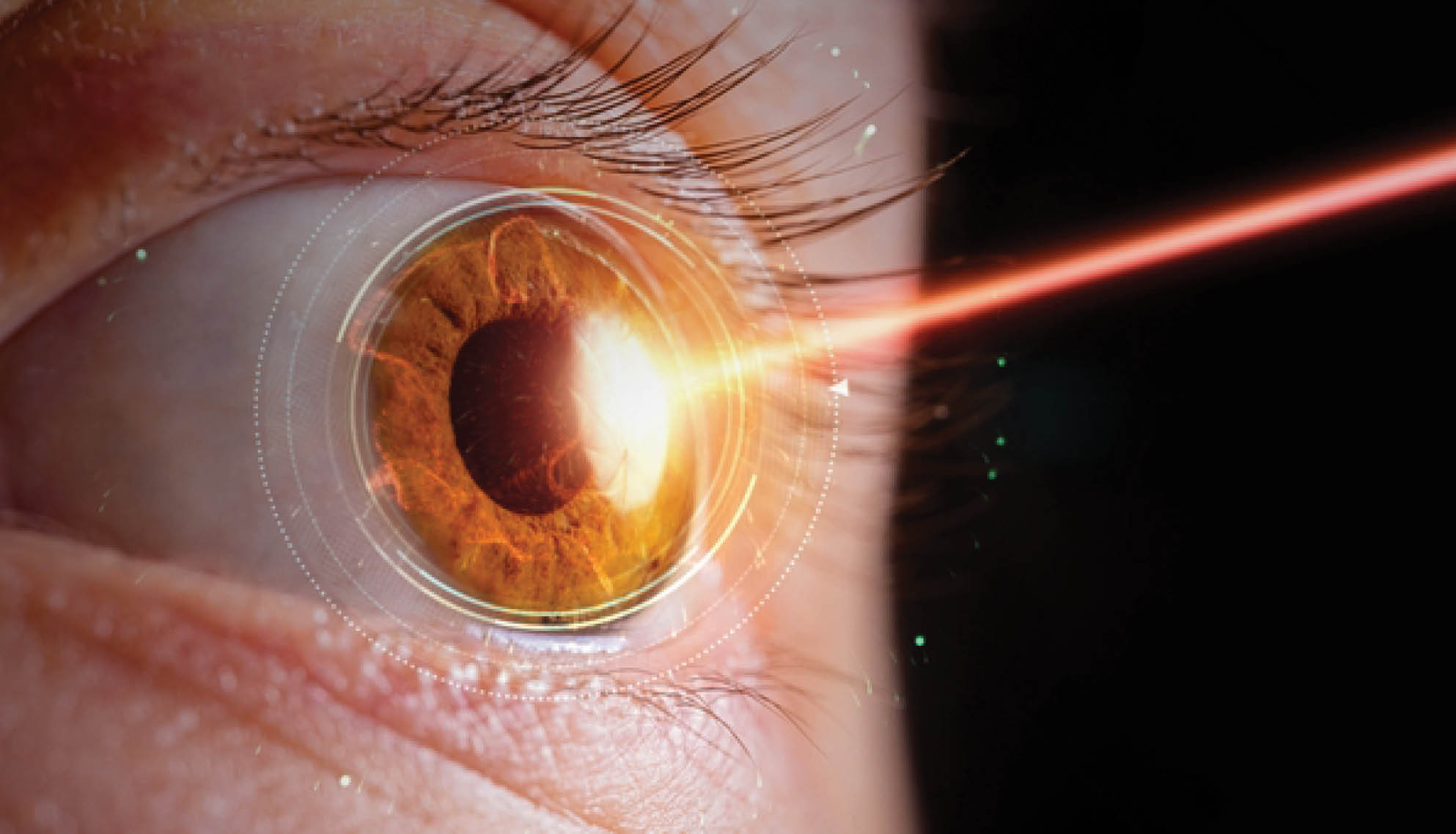 https://soliseyecare.com/wp-content/uploads/2025/07/LASIK_4.jpg
