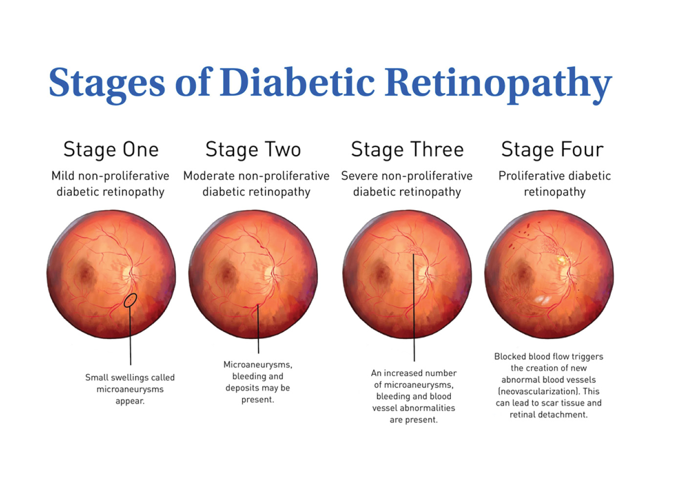 https://soliseyecare.com/wp-content/uploads/2025/10/Diabetic-Retinopathy_01.jpg